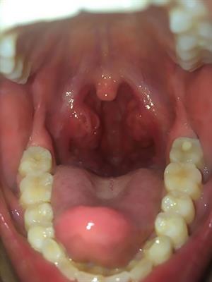 Case report: Metagenomics next-generation sequencing in the diagnosis of septic shock due to Fusobacterium necrophorum in a 6-year-old child